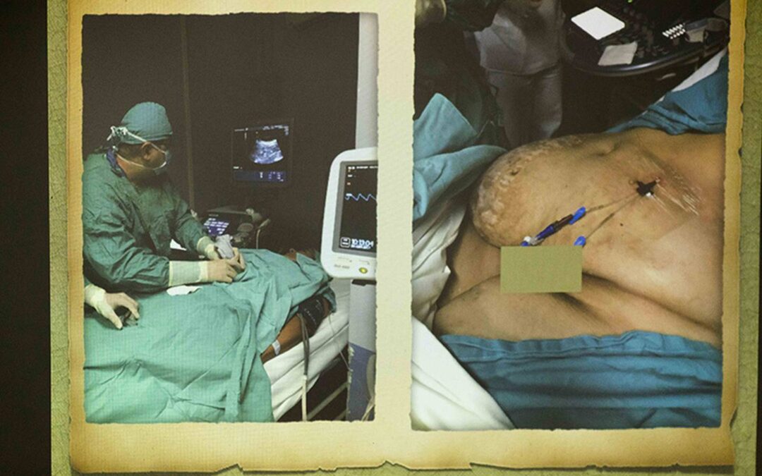 Mujer estuvo 2 años con una hernia gigante
