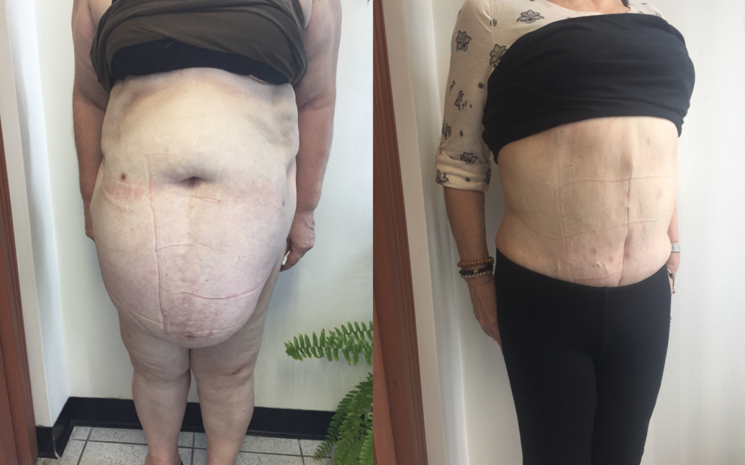Beneficios de la cirugía bariátrica en pacientes con hernia